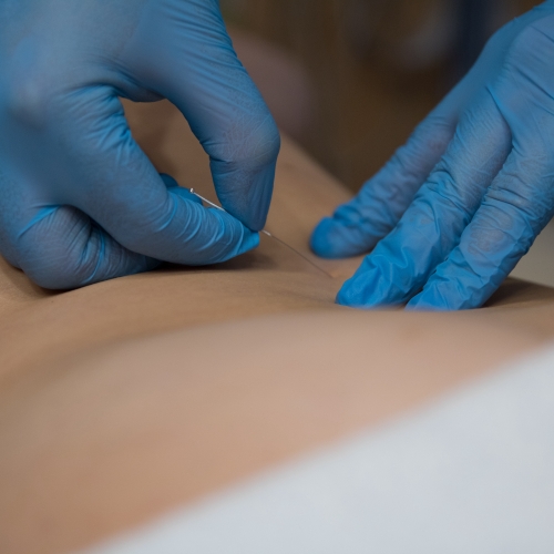 dry-needling-therasport-physical-therapy-merchantville-sewell-nj